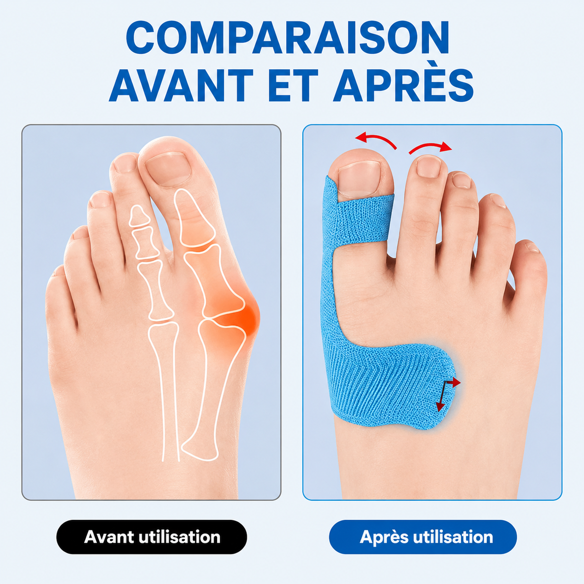 Comforté™ — Forskåret hallux valgus-tape, kinesiologi, aktiv komfort